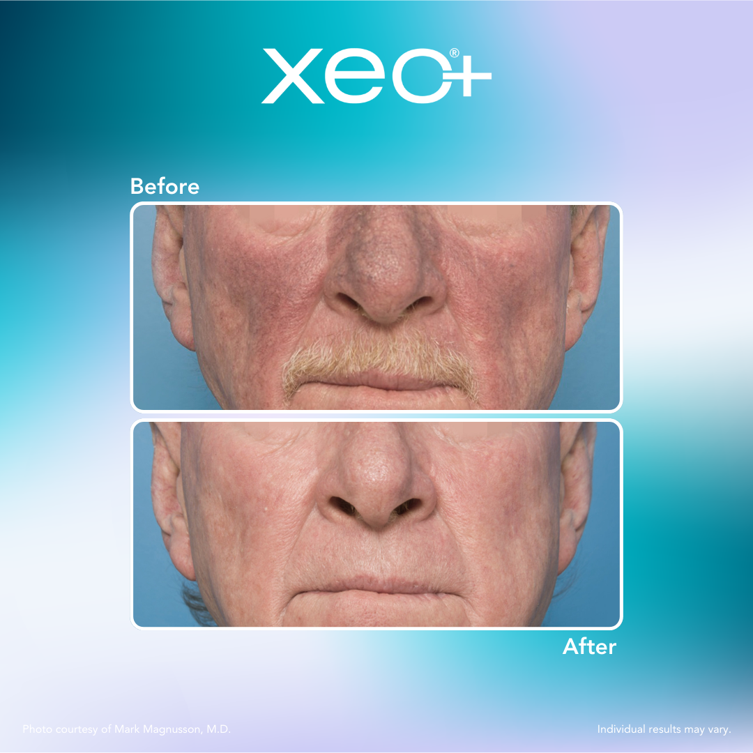 Total Laser Thread Laser Thread Vein Treatment Edinburgh | Stockbridge Clinic