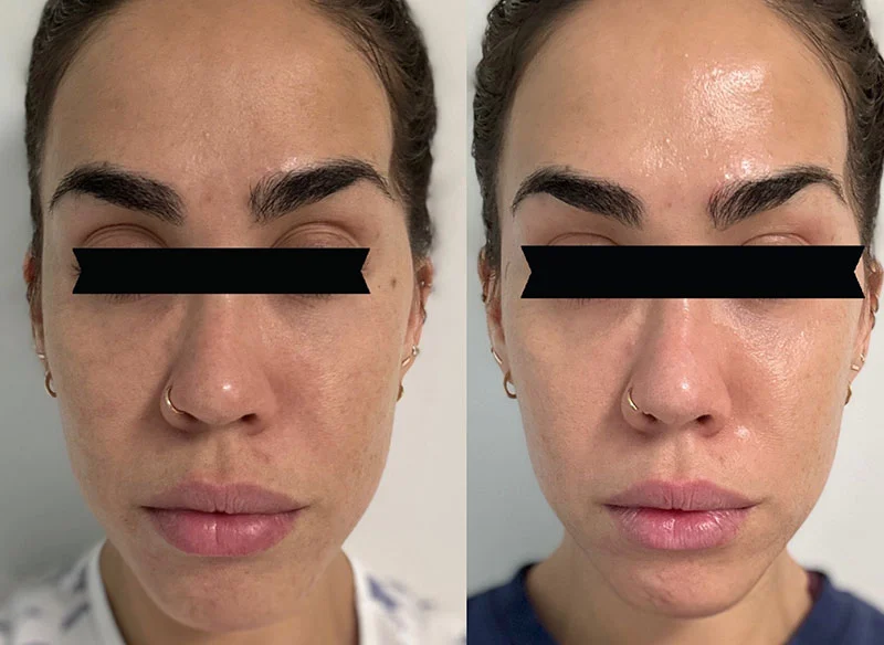 Exosome Therapy before and after result