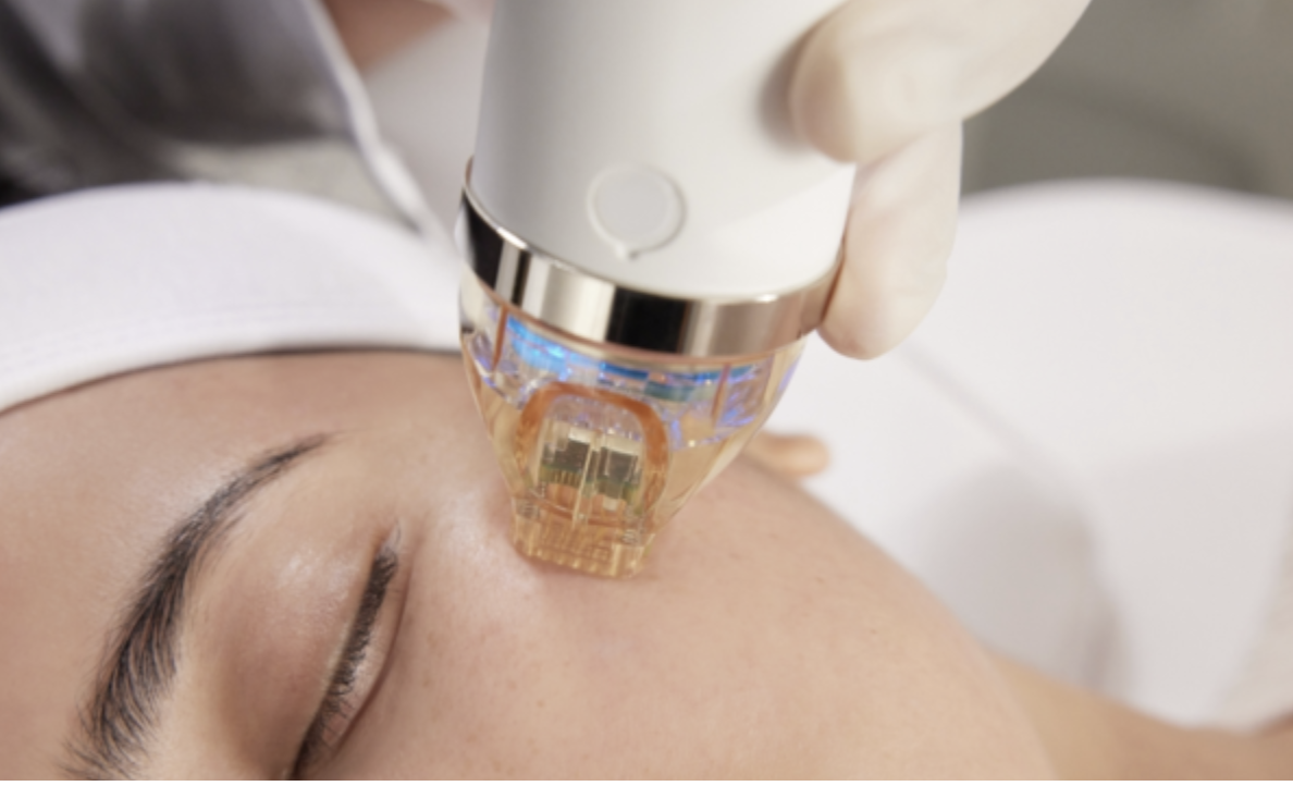 Secret RF microneedling treatment at The Stockbridge Clinic Edinburgh